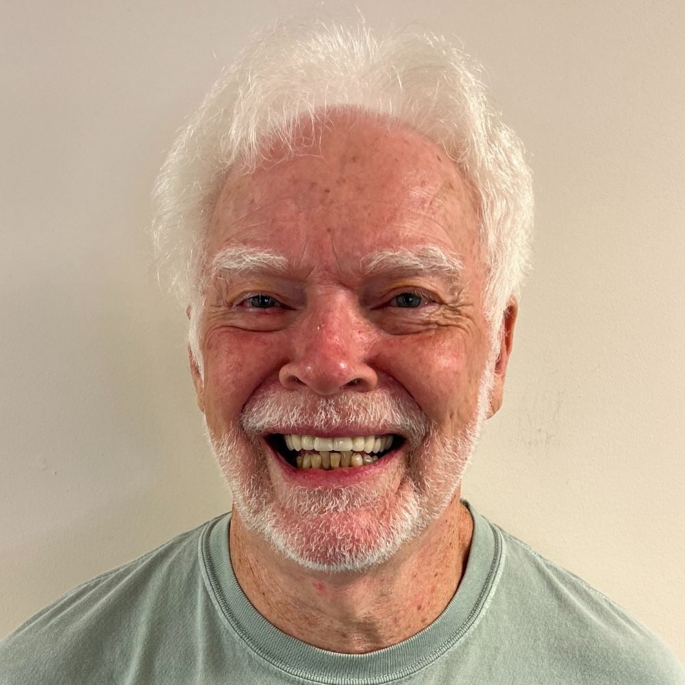 Cosmetic smile makeover at Atlee Dentistry
