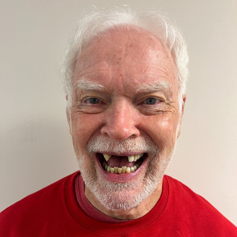 Cosmetic smile makeover at Atlee Dentistry
