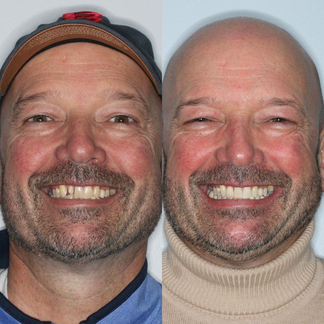 Invisalign