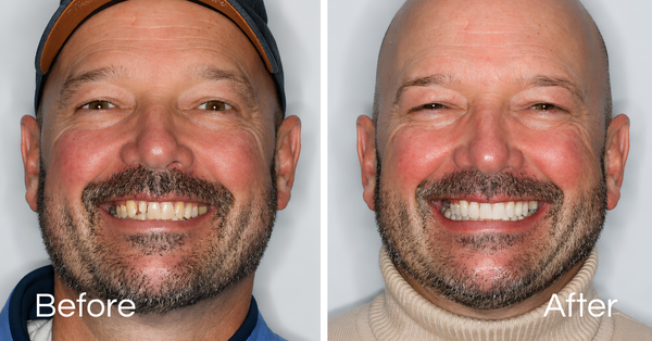 Before And Afters Crowns