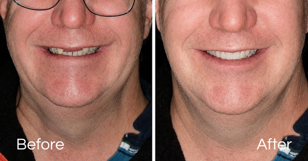 Before And Afters Dental Implants