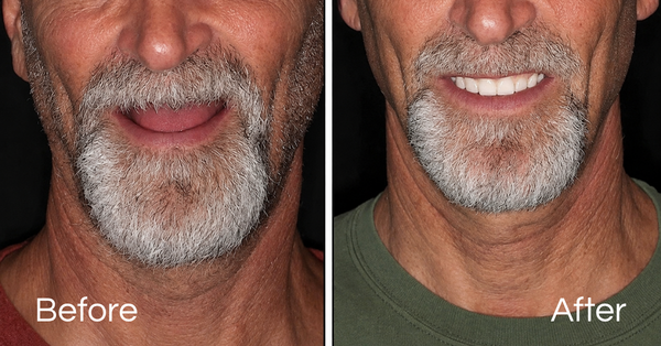 Before And Afters Dental Implants