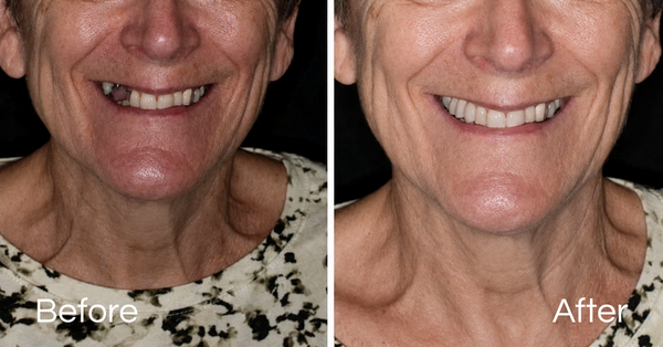 Before And Afters Dental Implants