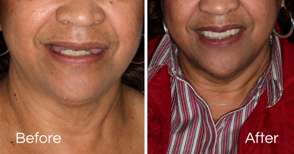 Before And Afters Dental Implants