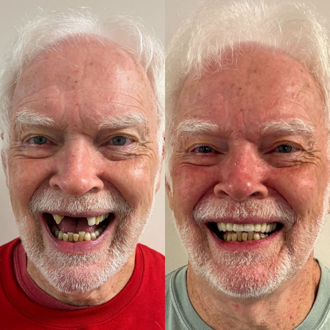 Invisalign - The Clear Alternative To Braces - Atlee Dentistry