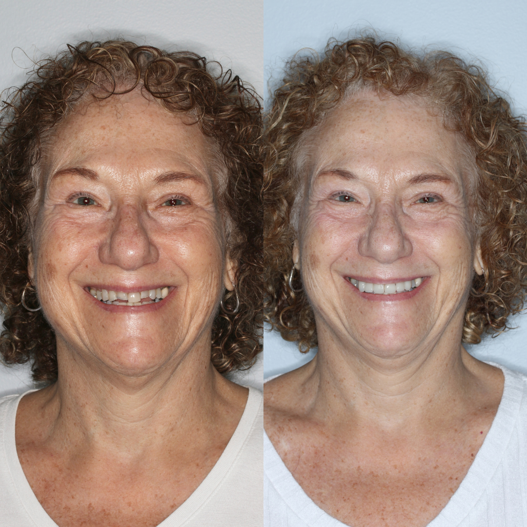 Before And Afters Smile Makeover