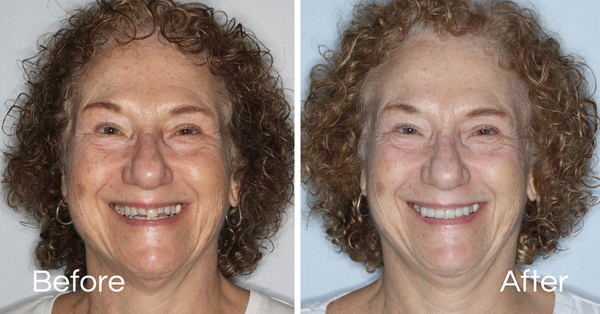 Gallery Before And Afters Smile Makeover