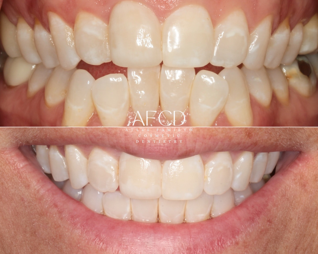 Invisalign Invisalign - Atlee Family & Cosmetic Dentistry