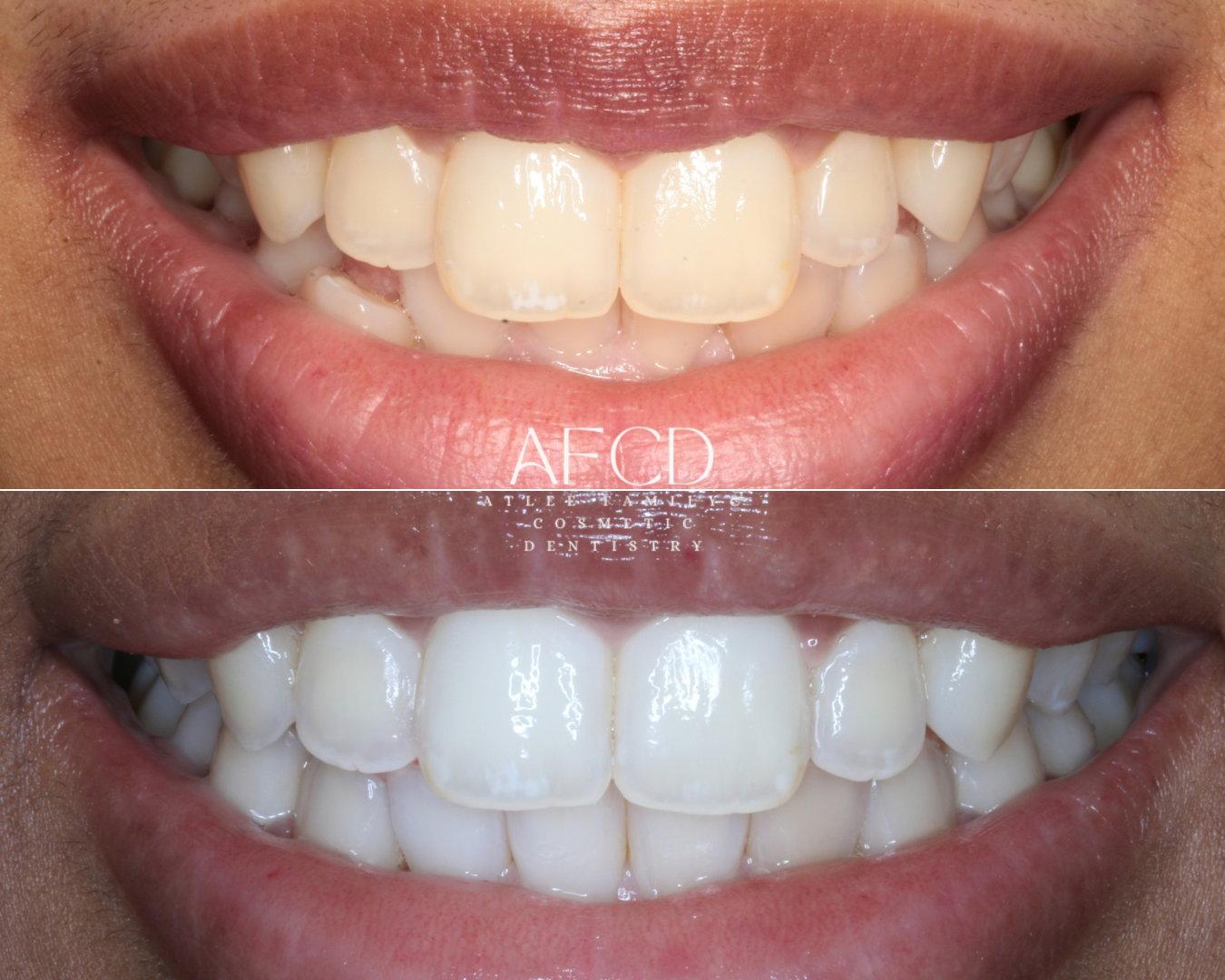 Invisalign Invisalign - Atlee Family & Cosmetic Dentistry