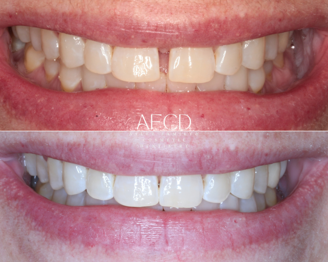 Invisalign Invisalign - Atlee Family & Cosmetic Dentistry