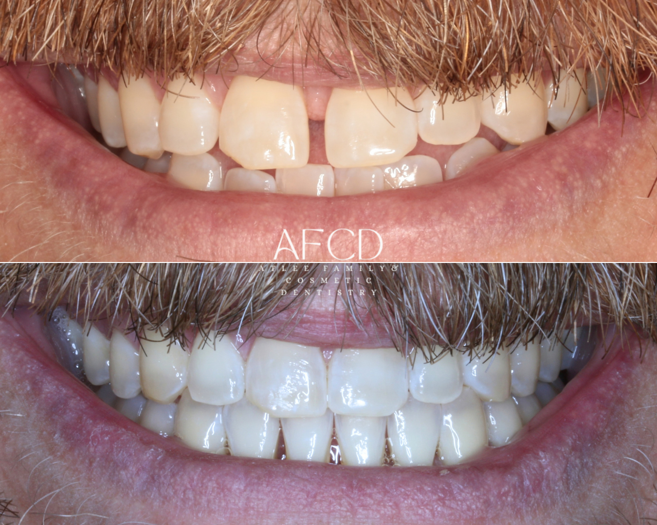 Invisalign Invisalign - Atlee Family & Cosmetic Dentistry