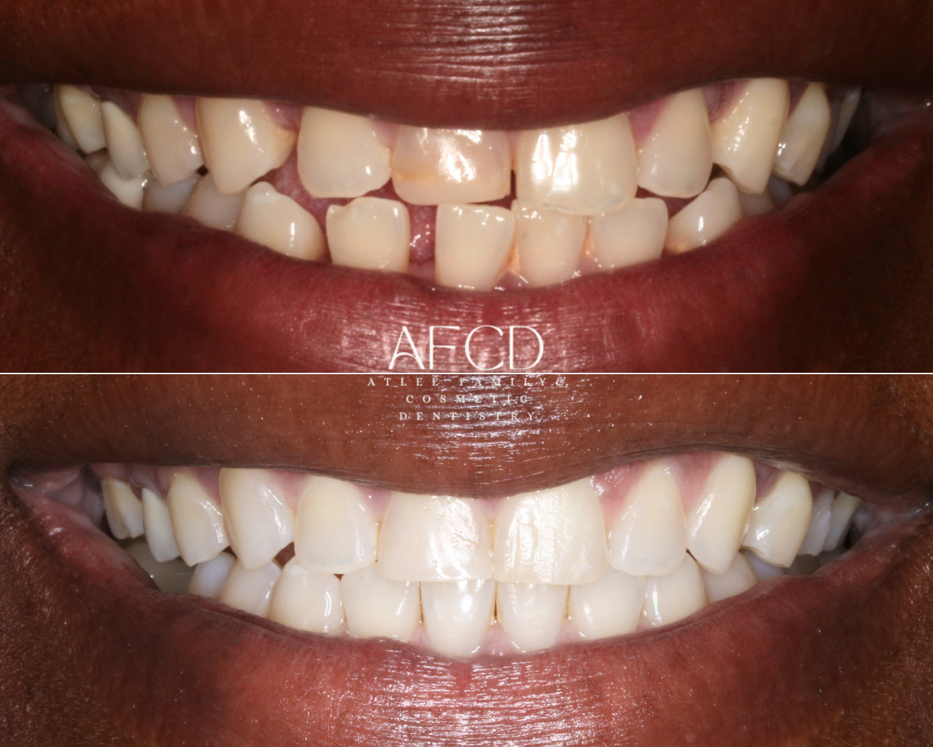 Invisalign Invisalign - Atlee Family & Cosmetic Dentistry