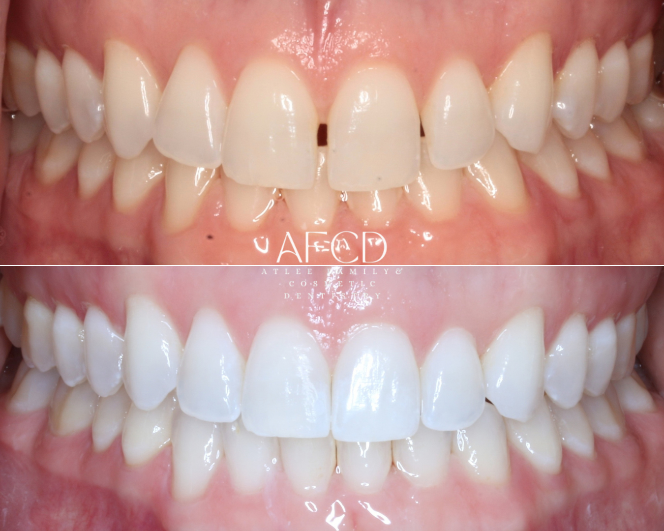 Invisalign Invisalign - Atlee Family & Cosmetic Dentistry