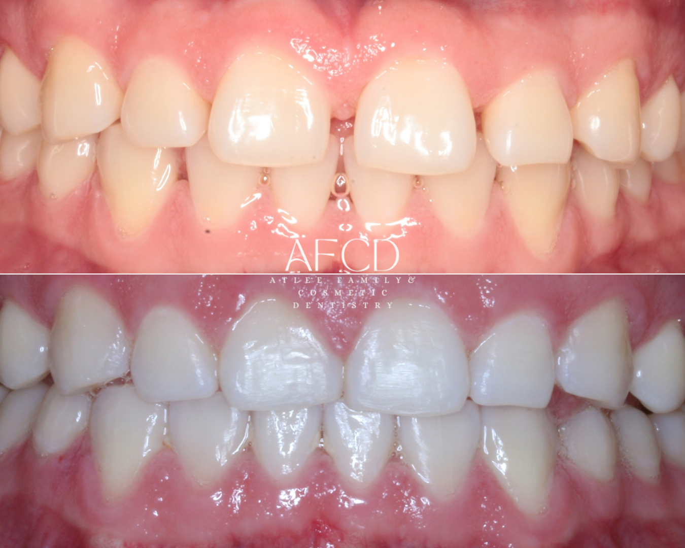 Invisalign Invisalign - Atlee Family & Cosmetic Dentistry