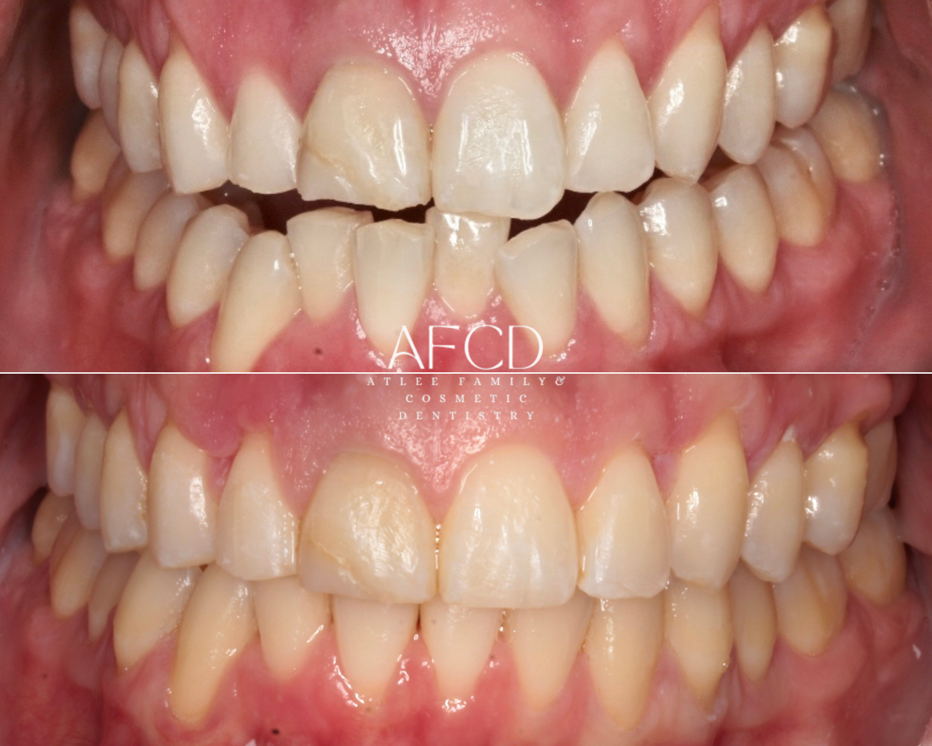 Invisalign Invisalign - Atlee Family & Cosmetic Dentistry