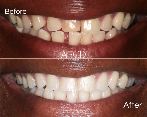 Gallery Invisalign - Atlee Family & Cosmetic Dentistry - Gallery Page