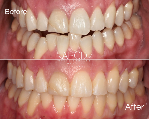 Gallery Invisalign - Atlee Family & Cosmetic Dentistry - Gallery Page