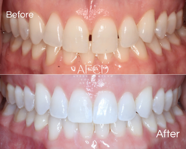 Gallery Invisalign - Atlee Family & Cosmetic Dentistry - Gallery Page