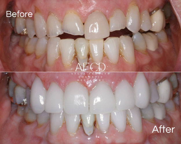 Invisalign - Atlee Family & Cosmetic Dentistry - Gallery Page