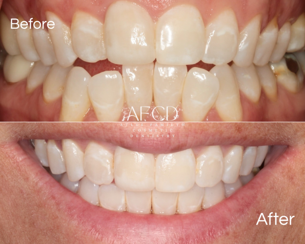 Gallery Invisalign - Atlee Family & Cosmetic Dentistry - Gallery Page