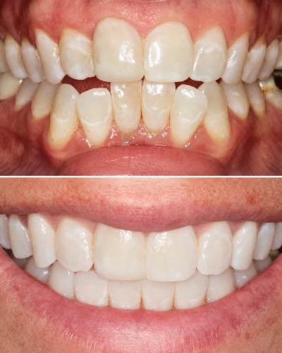 Before And Afters Invisalign
