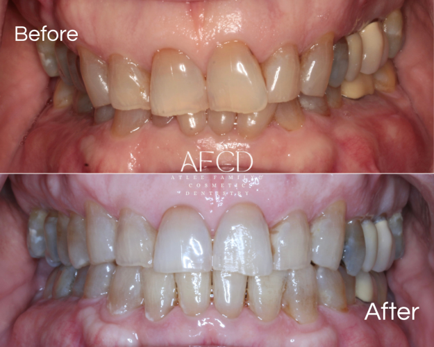 Invisalign - Atlee Family & Cosmetic Dentistry - Gallery Page