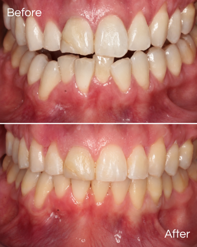 Before And Afters Invisalign