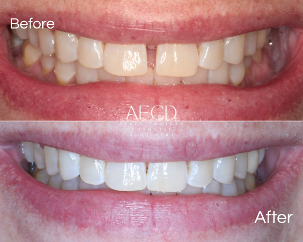 Gallery Invisalign - Atlee Family & Cosmetic Dentistry - Gallery Page
