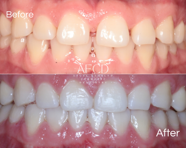 Gallery Invisalign - Atlee Family & Cosmetic Dentistry - Gallery Page
